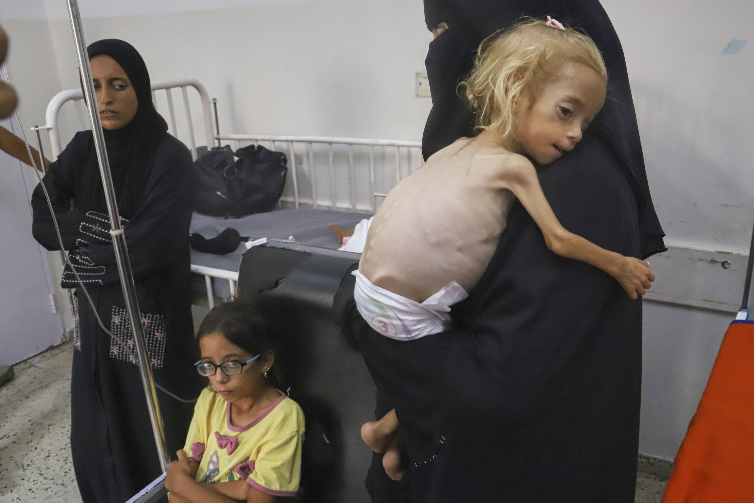 Islam Qudeih holds her severely malnourished 2-year-old daughter, Shamm, at Nasser Hospital in Khan Younis, southern Gaza Strip, Aug. 9, 2025. (AP Photo/Mariam Dagga)